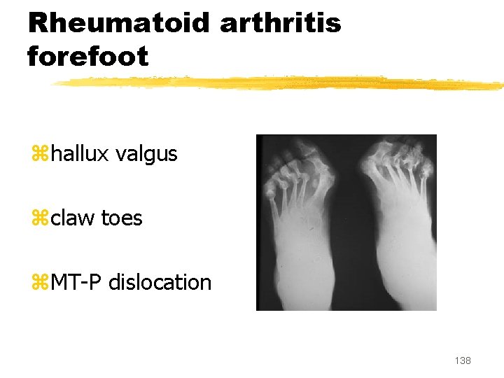 Rheumatoid arthritis forefoot zhallux valgus zclaw toes z. MT-P dislocation 138 