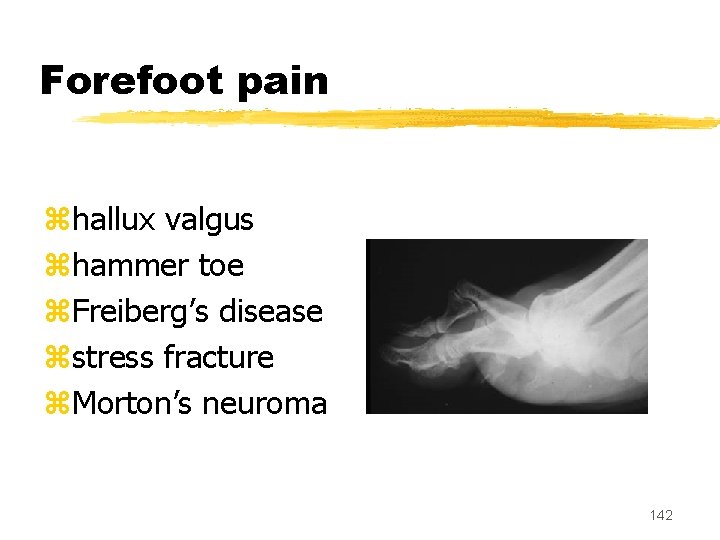 Forefoot pain zhallux valgus zhammer toe z. Freiberg’s disease zstress fracture z. Morton’s neuroma