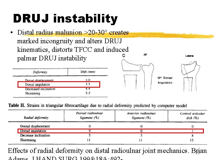 DRUJ instability • Distal radius malunion >20 -30° creates marked incongruity and alters DRUJ