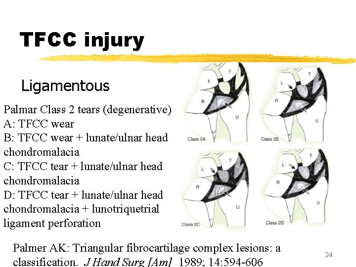 TFCC injury Ligamentous Palmar Class 2 tears (degenerative) A: TFCC wear B: TFCC wear