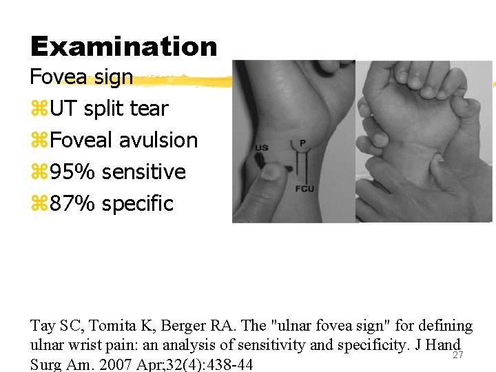 Examination Fovea sign z. UT split tear z. Foveal avulsion z 95% sensitive z