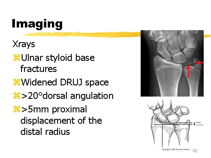 Imaging Xrays z. Ulnar styloid base fractures z. Widened DRUJ space z>20°dorsal angulation z>5