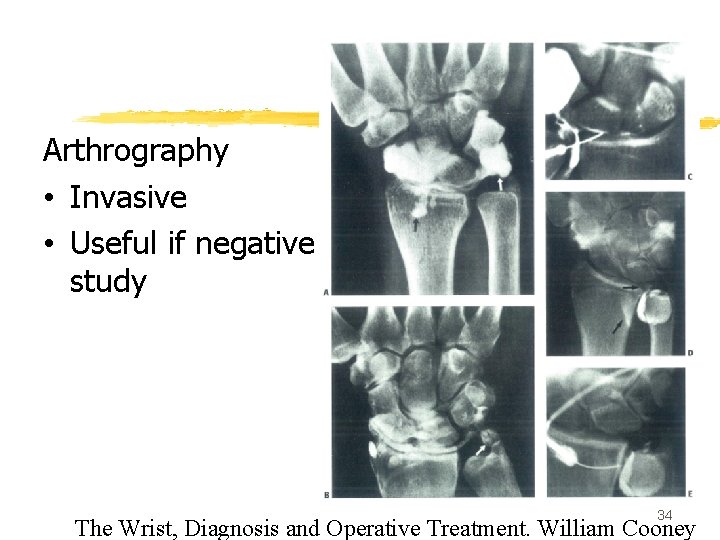 Arthrography • Invasive • Useful if negative study 34 The Wrist, Diagnosis and Operative