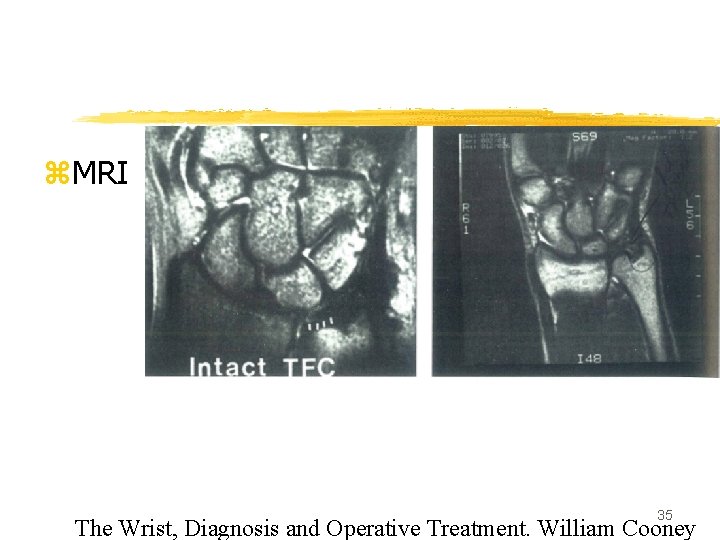 z. MRI 35 The Wrist, Diagnosis and Operative Treatment. William Cooney 