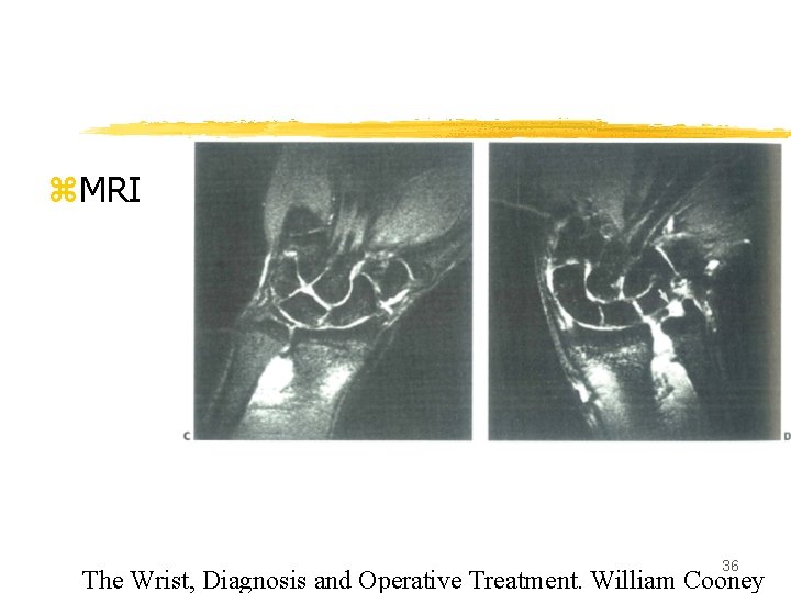 z. MRI 36 The Wrist, Diagnosis and Operative Treatment. William Cooney 
