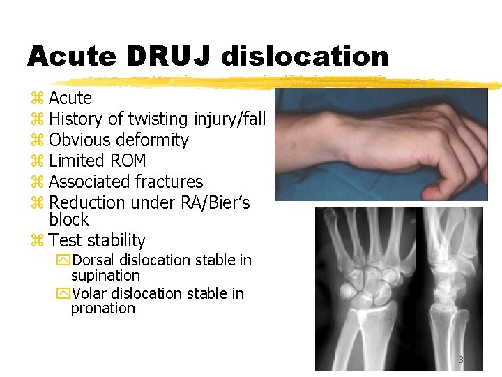Acute DRUJ dislocation z Acute z History of twisting injury/fall z Obvious deformity z