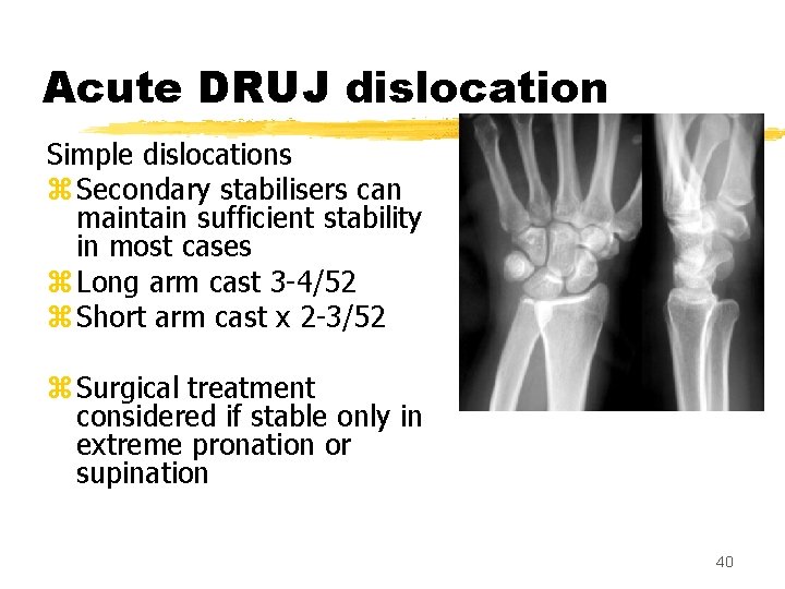 Acute DRUJ dislocation Simple dislocations z Secondary stabilisers can maintain sufficient stability in most