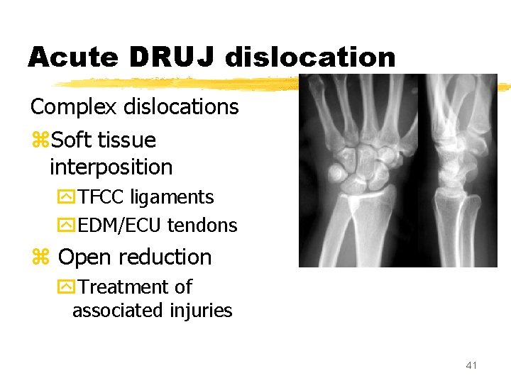 Acute DRUJ dislocation Complex dislocations z. Soft tissue interposition y. TFCC ligaments y. EDM/ECU