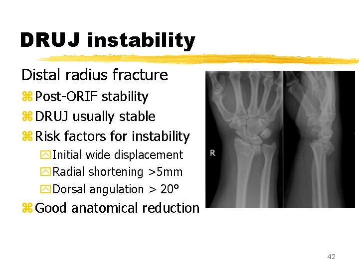 DRUJ instability Distal radius fracture z Post-ORIF stability z DRUJ usually stable z Risk