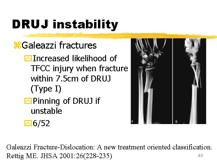 DRUJ instability z. Galeazzi fractures y. Increased likelihood of TFCC injury when fracture within