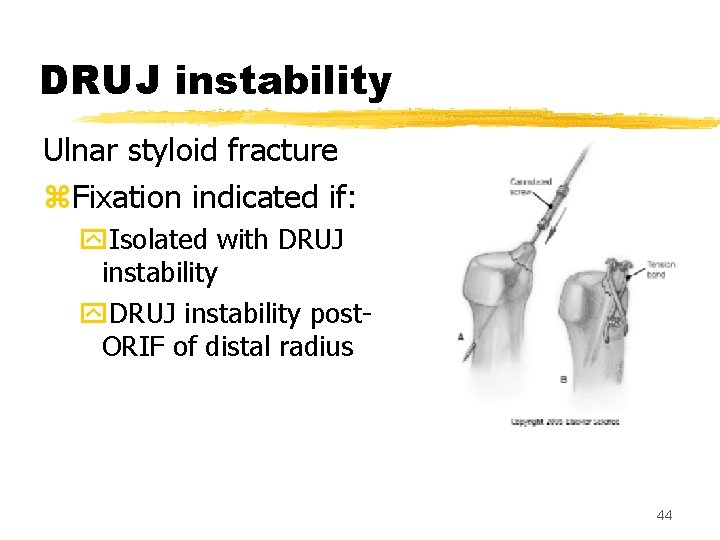 DRUJ instability Ulnar styloid fracture z. Fixation indicated if: y. Isolated with DRUJ instability