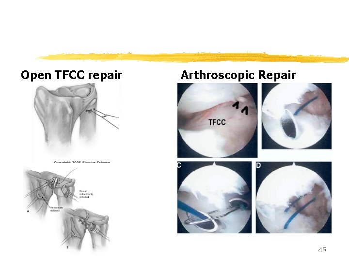 Open TFCC repair Arthroscopic Repair 45 