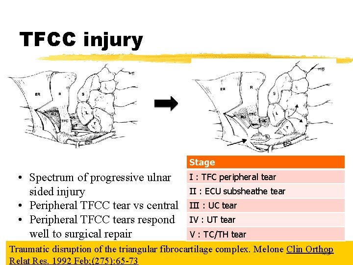 TFCC injury Stage • Spectrum of progressive ulnar sided injury • Peripheral TFCC tear