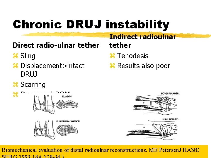 Chronic DRUJ instability Direct radio-ulnar tether z Sling z Displacement>intact DRUJ z Scarring z