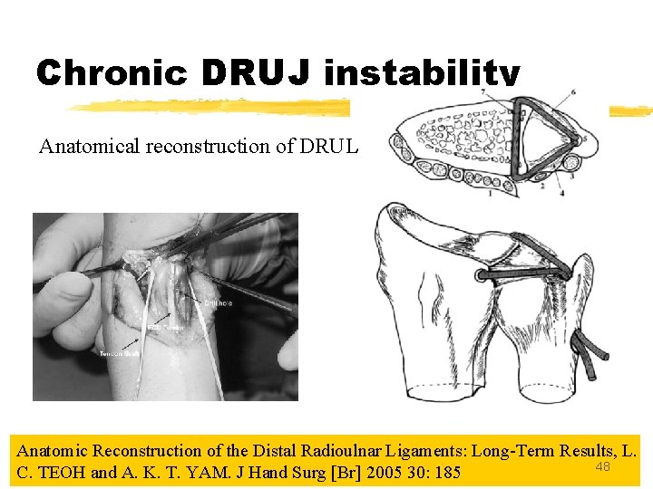 Chronic DRUJ instability Anatomical reconstruction of DRUL Anatomic Reconstruction of the Distal Radioulnar Ligaments: