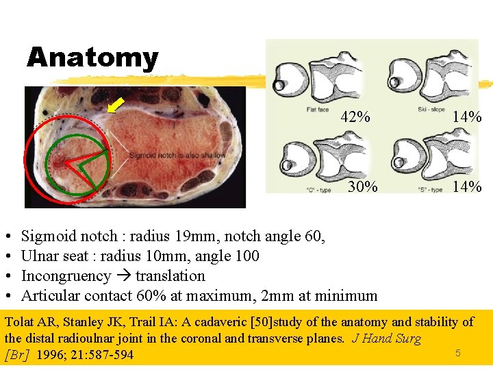 Anatomy 42% 14% xx 30% • • 14% Sigmoid notch : radius 19 mm,