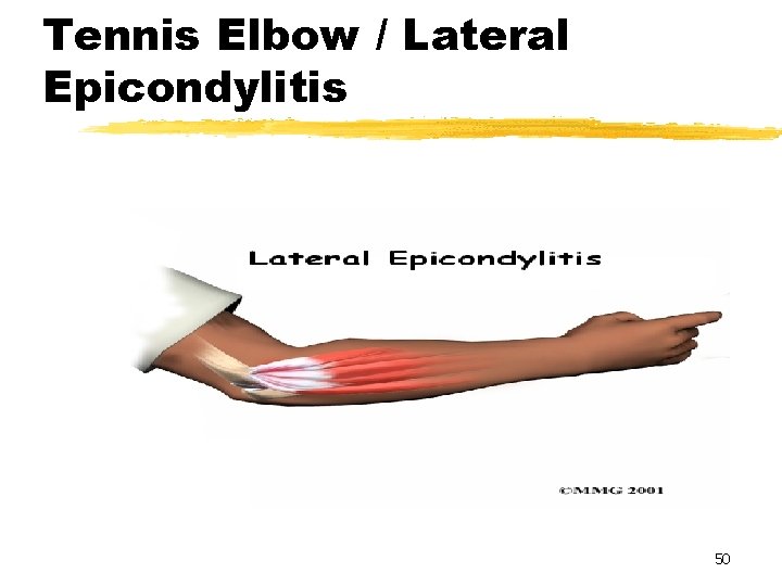 Tennis Elbow / Lateral Epicondylitis 50 