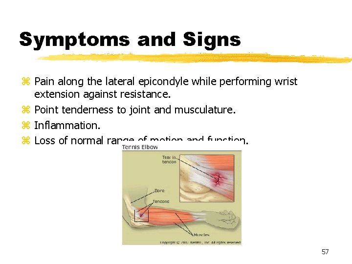 Symptoms and Signs z Pain along the lateral epicondyle while performing wrist extension against