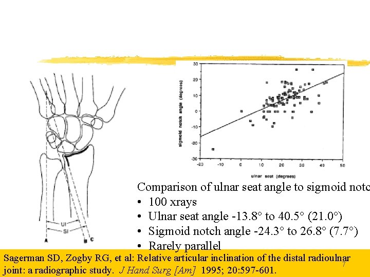 Comparison of ulnar seat angle to sigmoid notc • 100 xrays • Ulnar seat