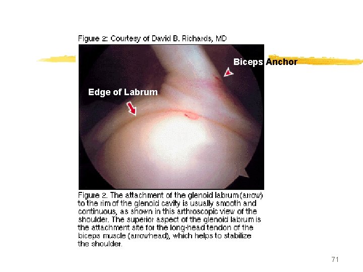 Biceps Anchor Edge of Labrum 71 