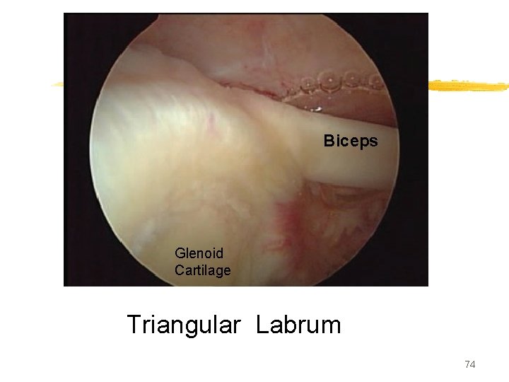 Biceps Glenoid Cartilage Triangular Labrum 74 