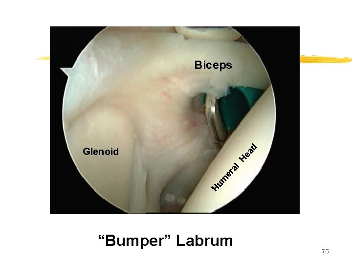 Biceps Hu m er al He ad Glenoid “Bumper” Labrum 75 