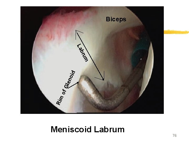 Biceps Rim of Gle no id rum b La Meniscoid Labrum 76 