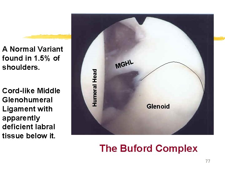 Cord-like Middle Glenohumeral Ligament with apparently deficient labral tissue below it. L Humeral Head