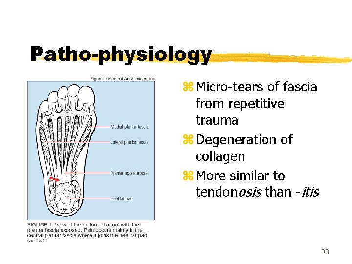 Patho-physiology z Micro-tears of fascia from repetitive trauma z Degeneration of collagen z More