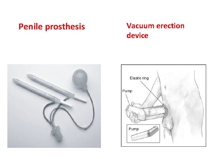 Penile prosthesis Vacuum erection device Penile prosthesis Vacuum erection device