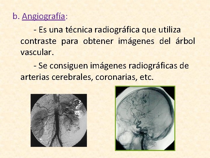 b. Angiografía: - Es una técnica radiográfica que utiliza contraste para obtener imágenes del