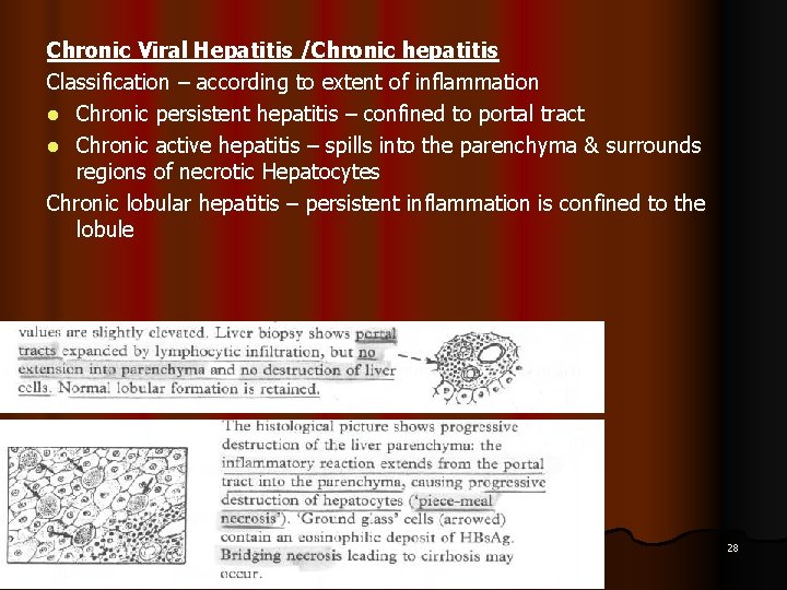 Chronic Viral Hepatitis /Chronic hepatitis Classification – according to extent of inflammation l Chronic