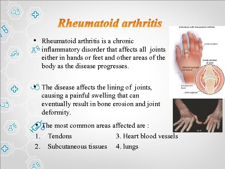  • Rheumatoid arthritis is a chronic inflammatory disorder that affects all joints either