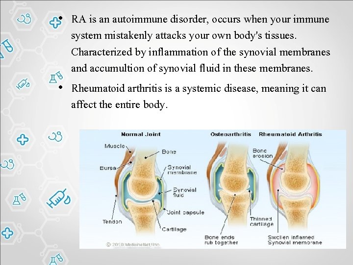  • RA is an autoimmune disorder, occurs when your immune system mistakenly attacks