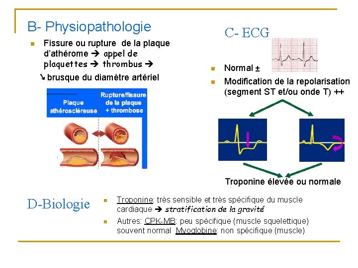 B- Physiopathologie n Fissure ou rupture de la plaque d’athérome appel de plaquettes thrombus