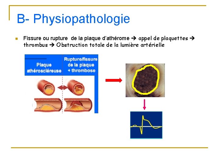 B- Physiopathologie n Fissure ou rupture de la plaque d’athérome appel de plaquettes thrombus