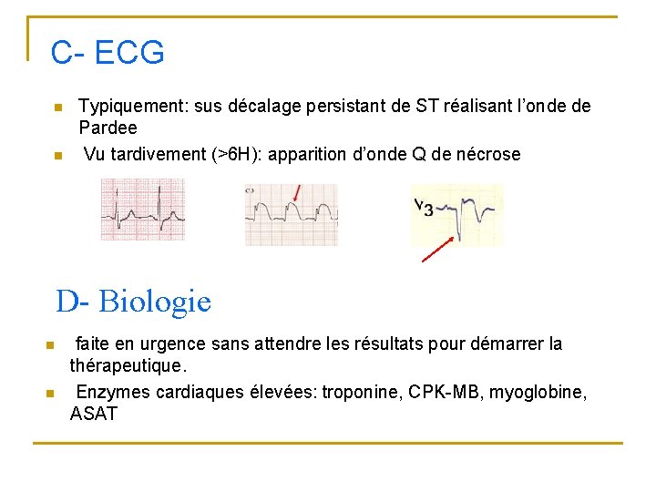 C- ECG n n Typiquement: sus décalage persistant de ST réalisant l’onde de Pardee C- ECG n n Typiquement: sus décalage persistant de ST réalisant l’onde de Pardee