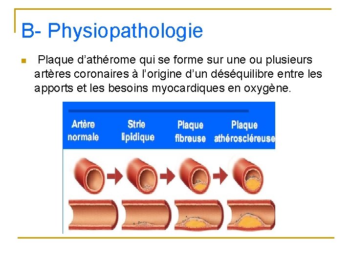 B- Physiopathologie n Plaque d’athérome qui se forme sur une ou plusieurs artères coronaires