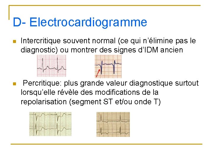 D- Electrocardiogramme n Intercritique souvent normal (ce qui n’élimine pas le diagnostic) ou montrer