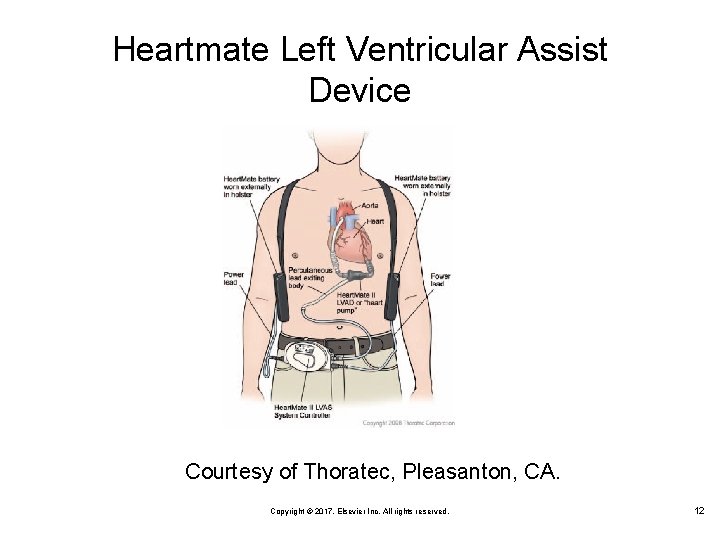 Heartmate Left Ventricular Assist Device Courtesy of Thoratec, Pleasanton, CA. Copyright © 2017, Elsevier