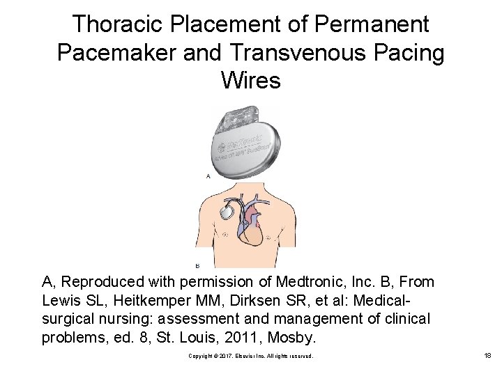 Thoracic Placement of Permanent Pacemaker and Transvenous Pacing Wires A, Reproduced with permission of