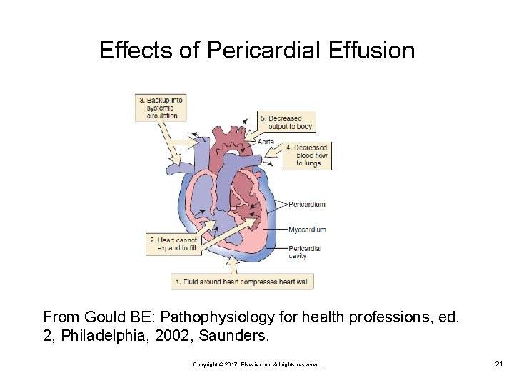 Effects of Pericardial Effusion From Gould BE: Pathophysiology for health professions, ed. 2, Philadelphia,