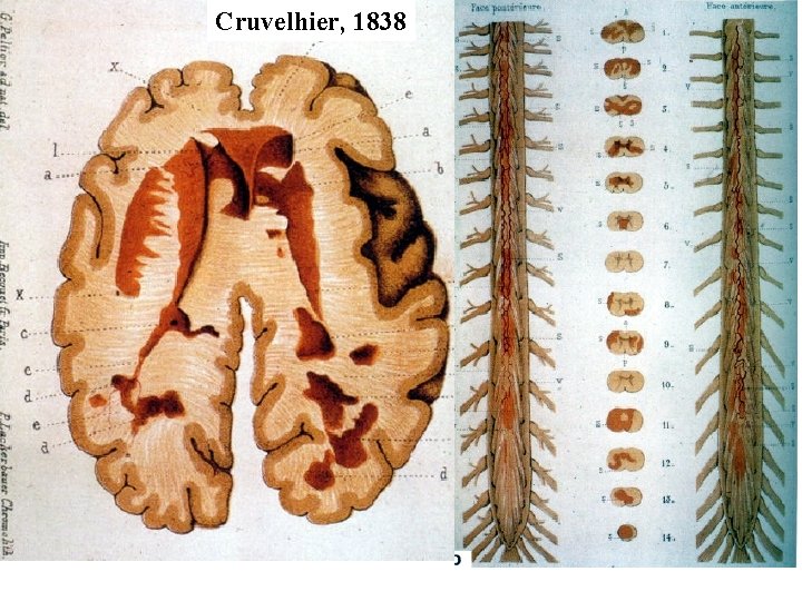 Cruvelhier, 1838 Cruvelhier, 1838