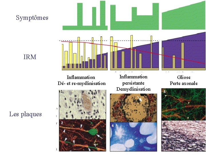 Symptômes IRM Inflammation Dé- et re-myélinisation Les plaques Inflammation persistante Demyélinisation Gliose Perte axonale Symptômes IRM Inflammation Dé- et re-myélinisation Les plaques Inflammation persistante Demyélinisation Gliose Perte axonale
