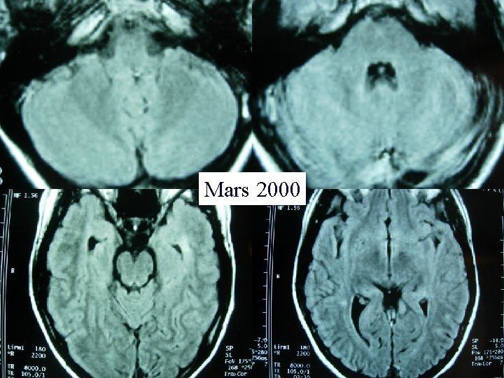 Mars 2000 Mars 2000
