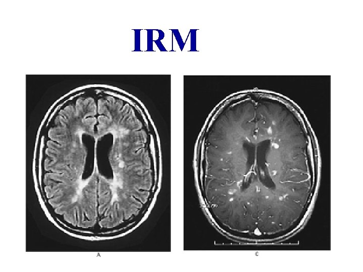 IRM IRM