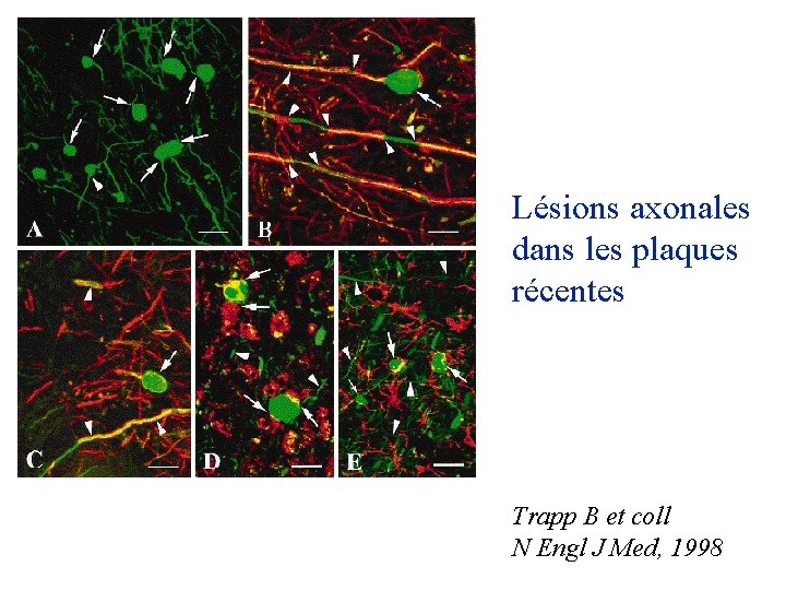 Lésions axonales dans les plaques récentes Trapp B et coll N Engl J Med, Lésions axonales dans les plaques récentes Trapp B et coll N Engl J Med,