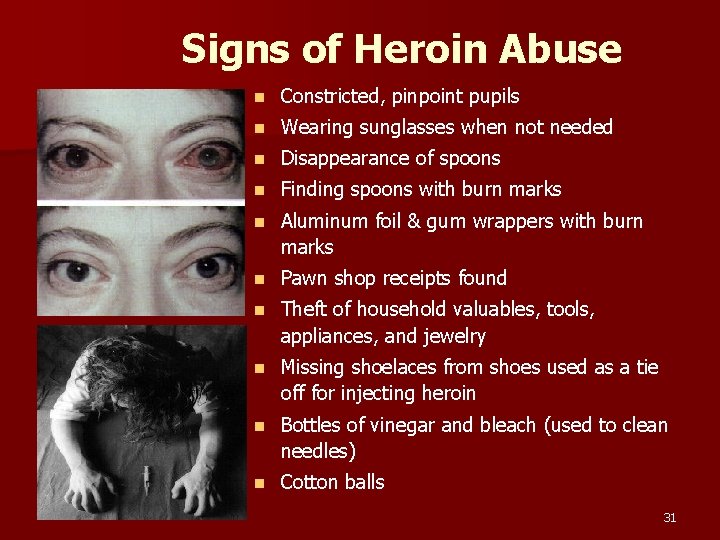 Signs of Heroin Abuse n Constricted, pinpoint pupils n Wearing sunglasses when not needed