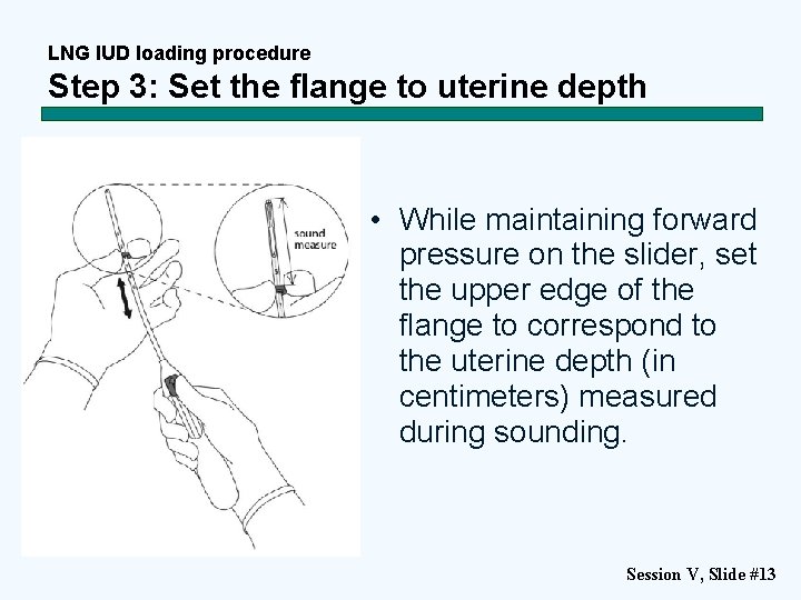 LNG IUD loading procedure Step 3: Set the flange to uterine depth • While