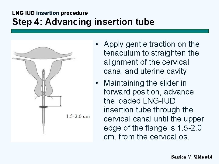 LNG IUD insertion procedure Step 4: Advancing insertion tube • Apply gentle traction on